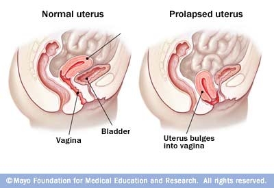 Prolaps vaginal si uterin